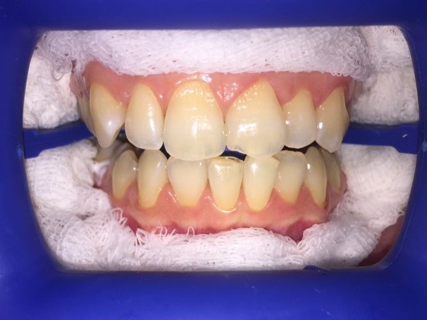 Отбеливание