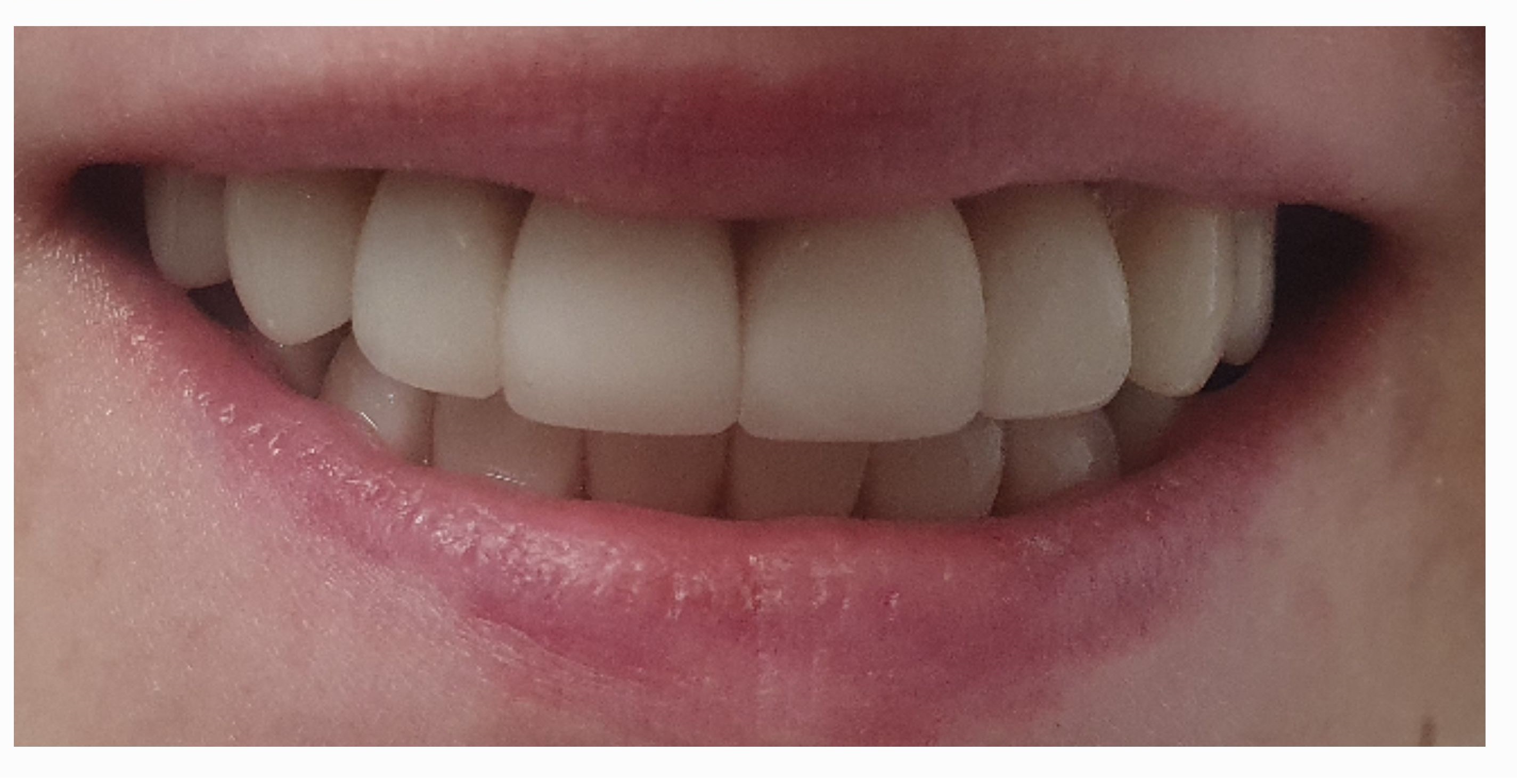 Композитные виниры