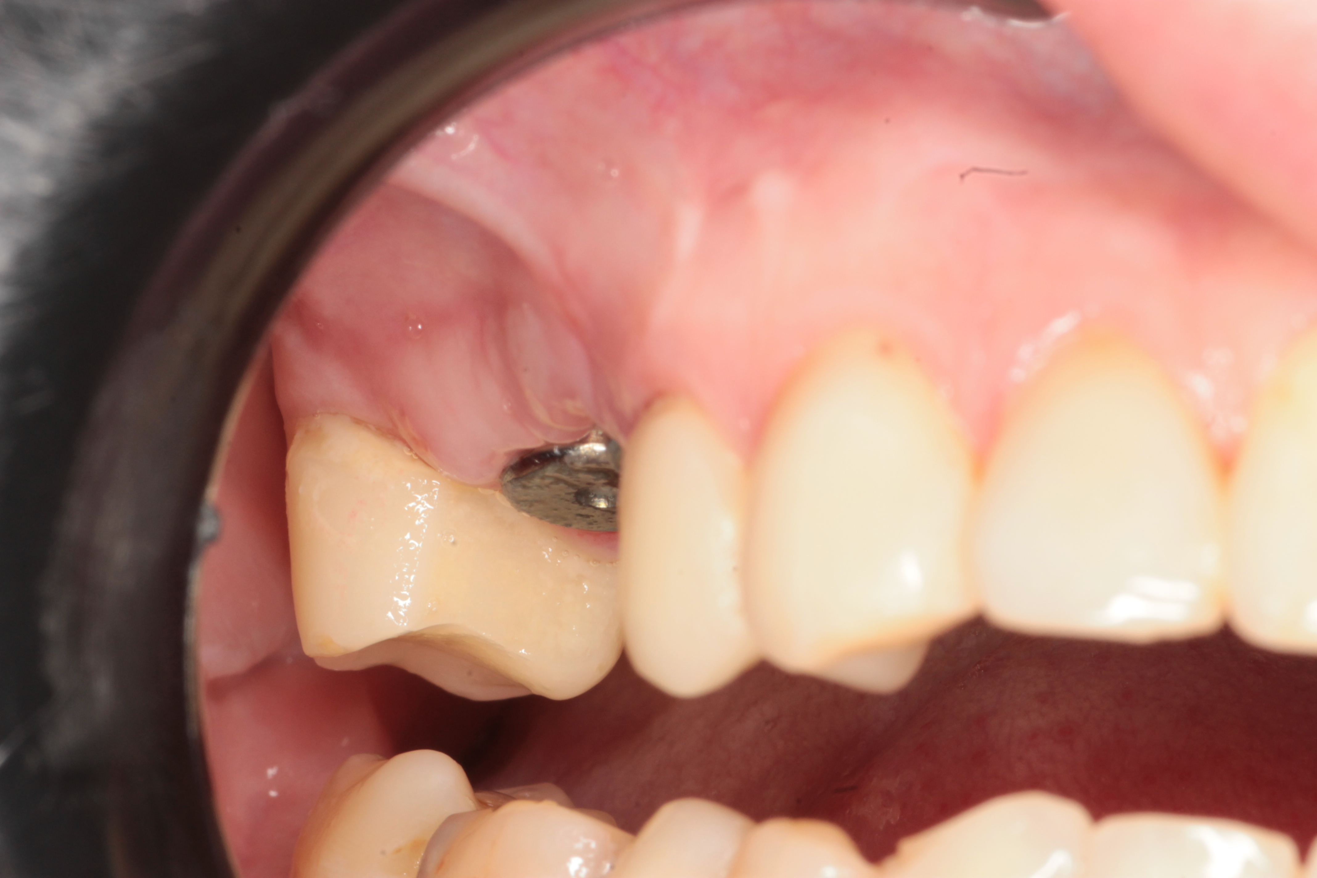 Десневая пластика в области имплантатов