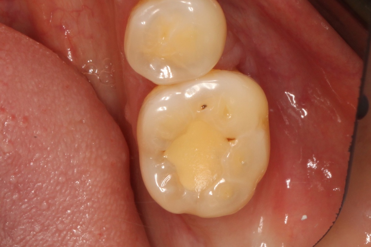 Лечение кариеса