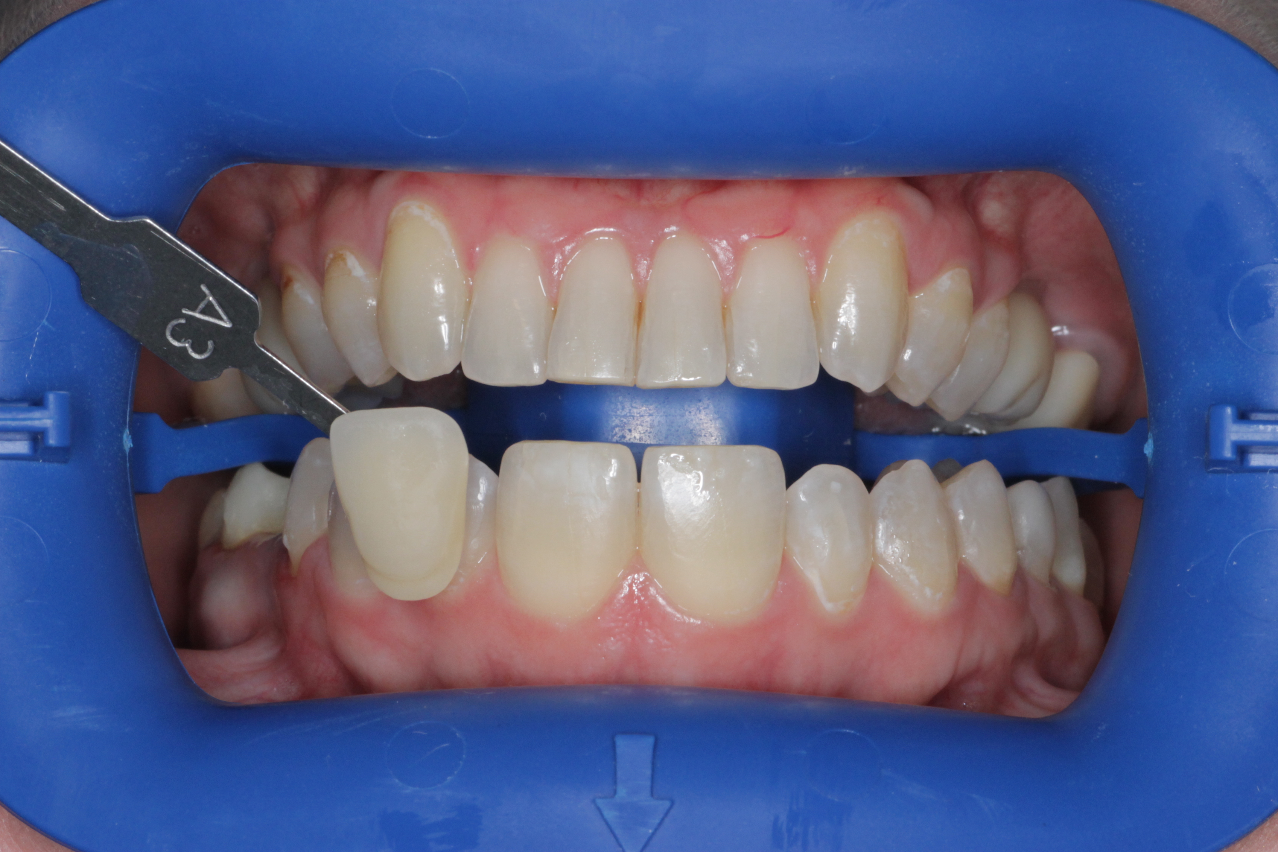 Отбеливание