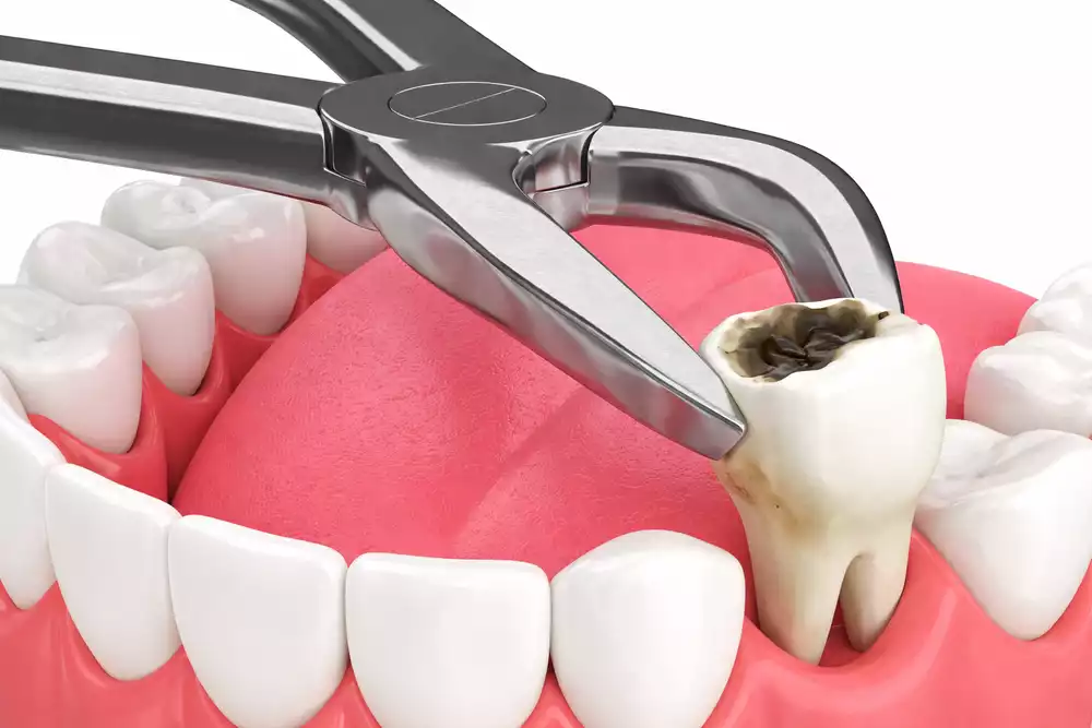 Температура после удаления зуба: норма или осложнение