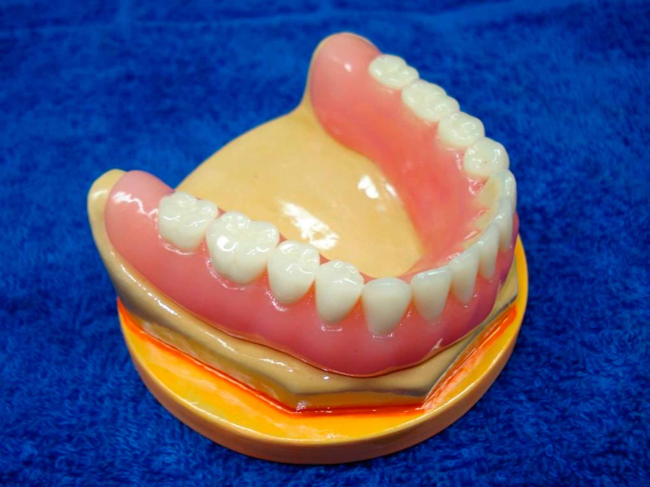 Зубной протез бабочка фото на верхнюю челюсть фото