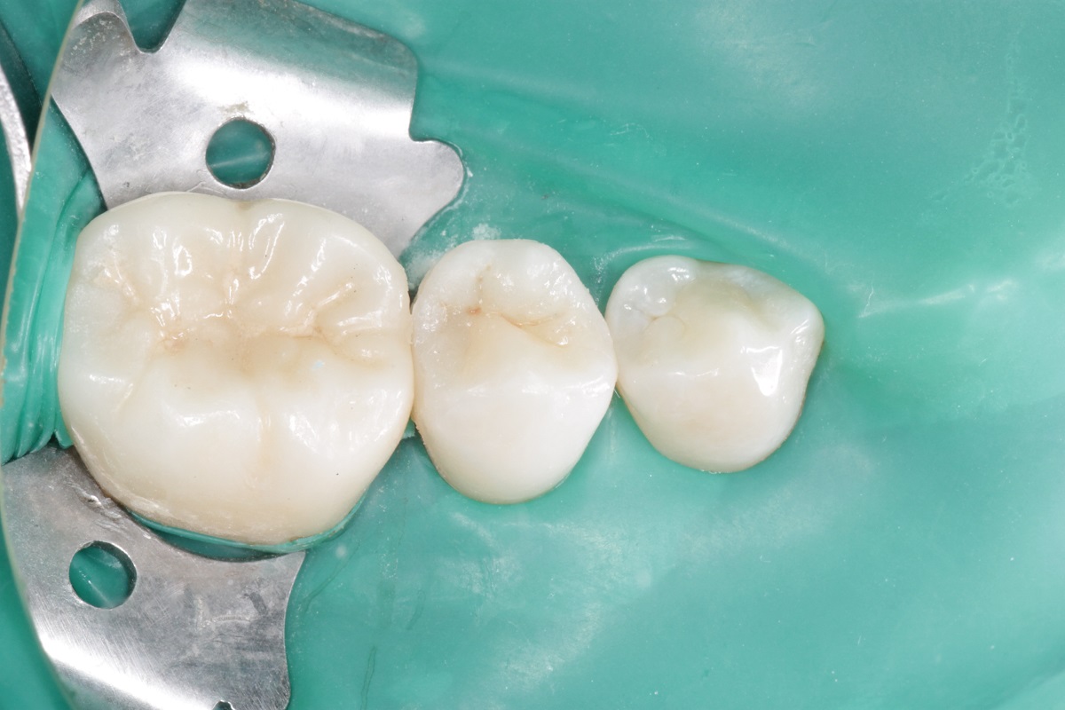 Лечение кариеса