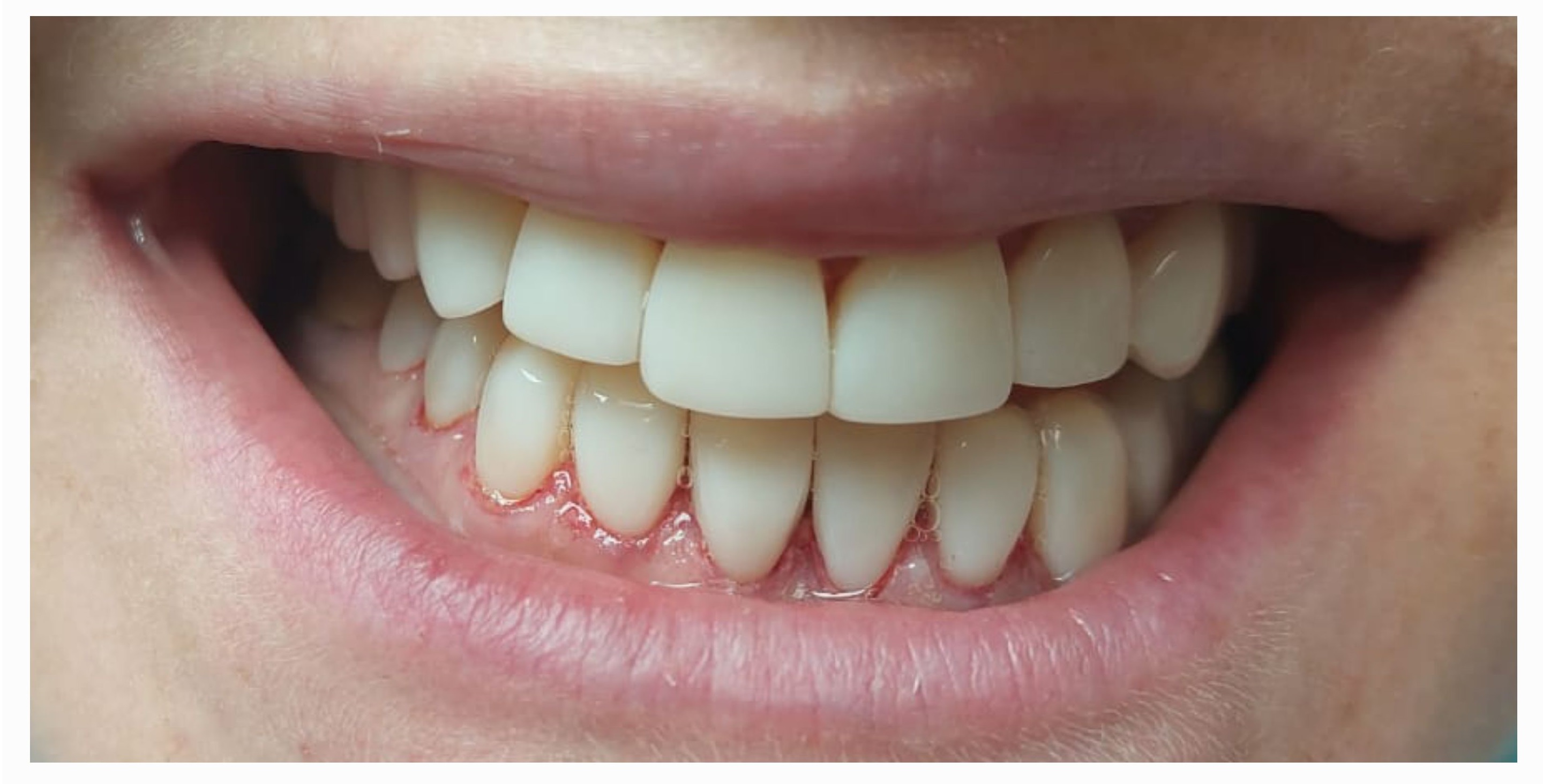 Композитные виниры