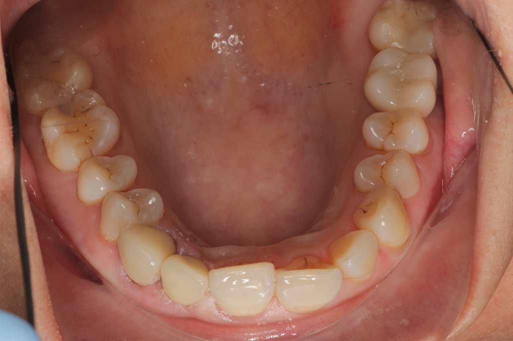 Имплантация зубов