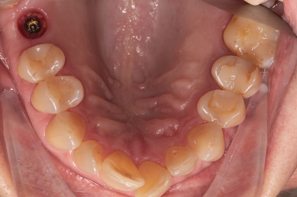 Установка имплантата