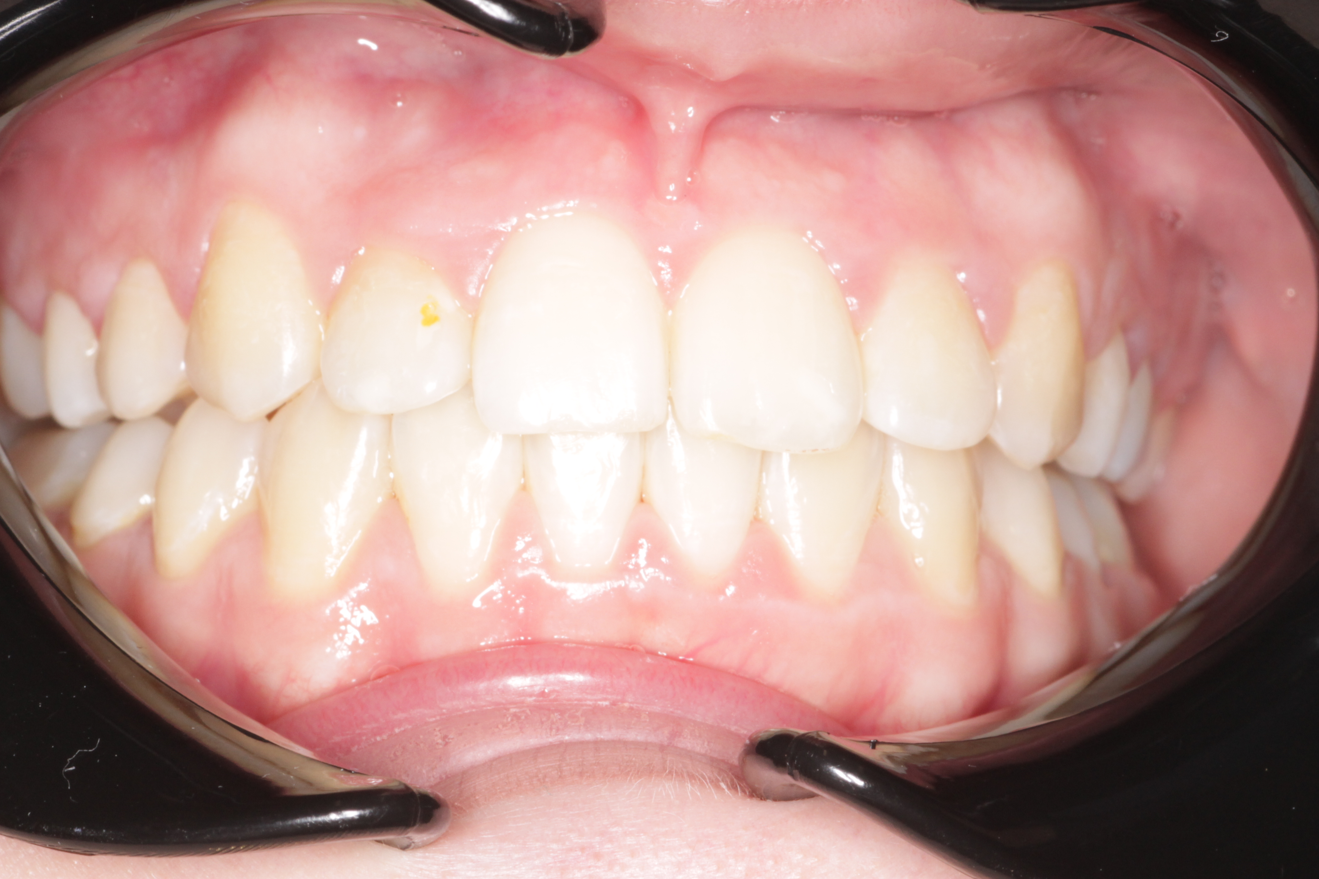 Исправление прикуса брекетами