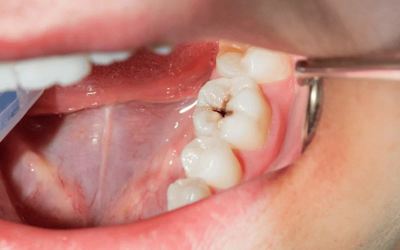 Почему разрушается эмаль зубов и что с этим делать