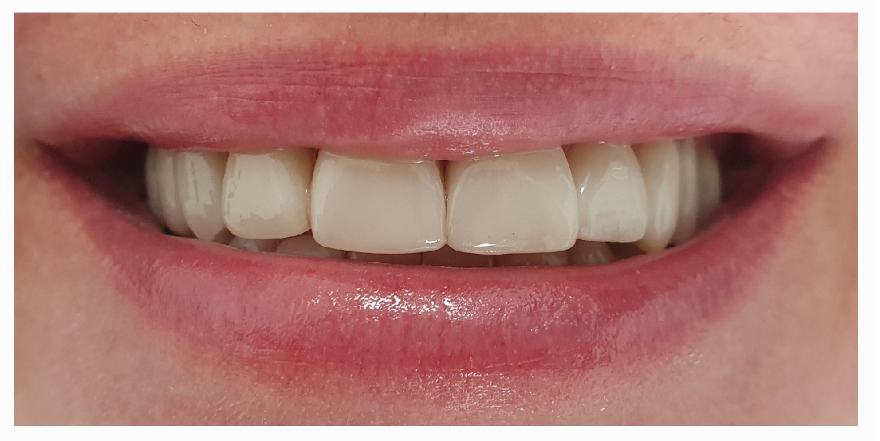 Композитные виниры