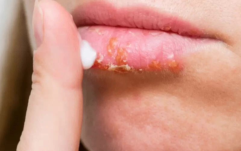 Стоматит – что это, как и чем лечить у взрослых