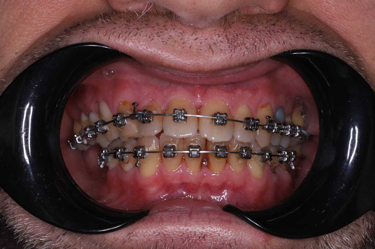 Лечение пародонтита