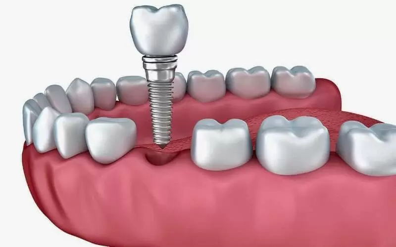 Какие анализы нужно сдать перед имплантацией зубов
