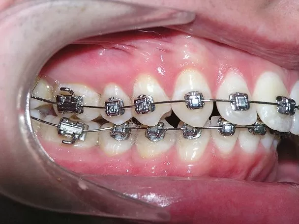 Металлические брекеты