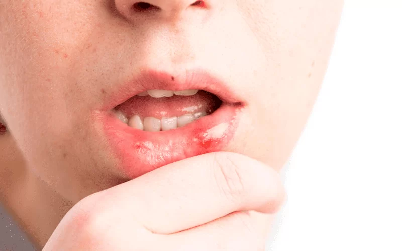 Стоматит – что это, как и чем лечить у взрослых