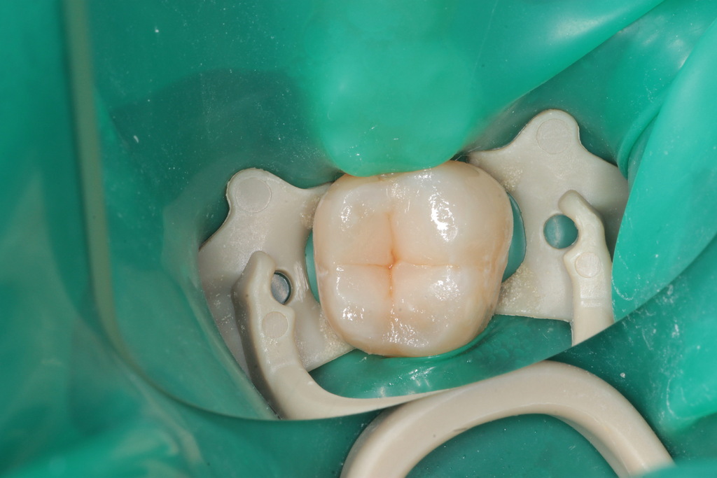 Лечение кариеса