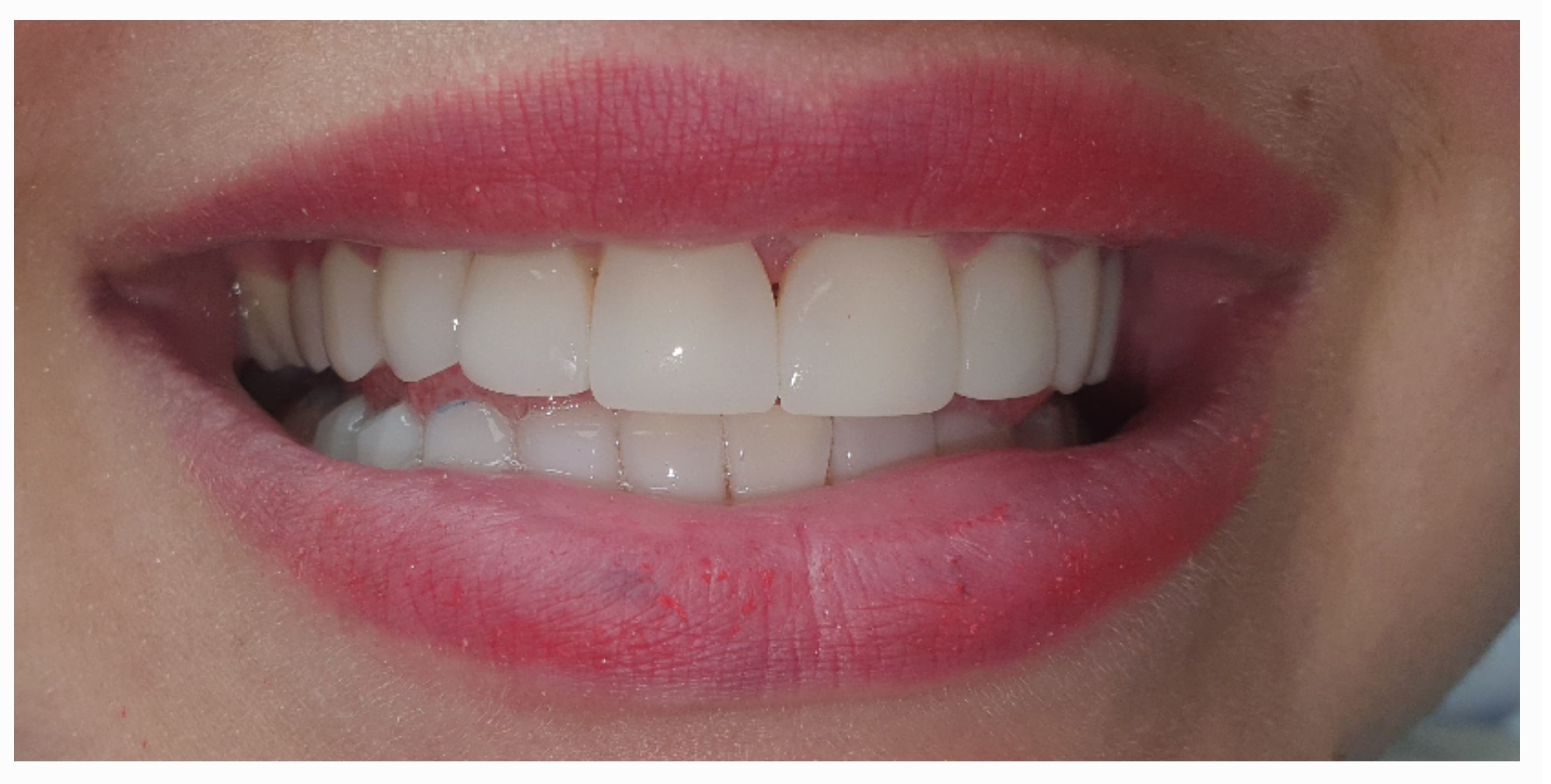 Композитные виниры