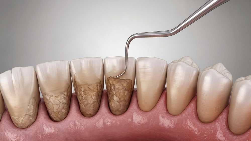 Вторичный кариес