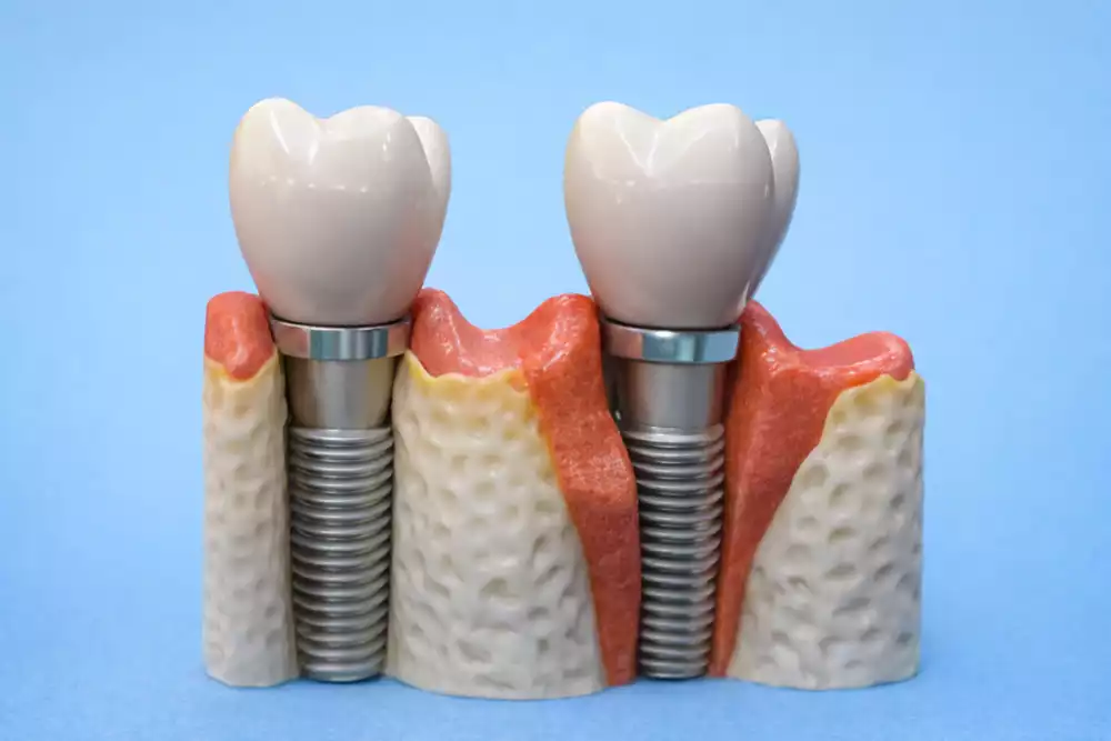 Периимплантит: причины воспаления вокруг импланта и методы лечения