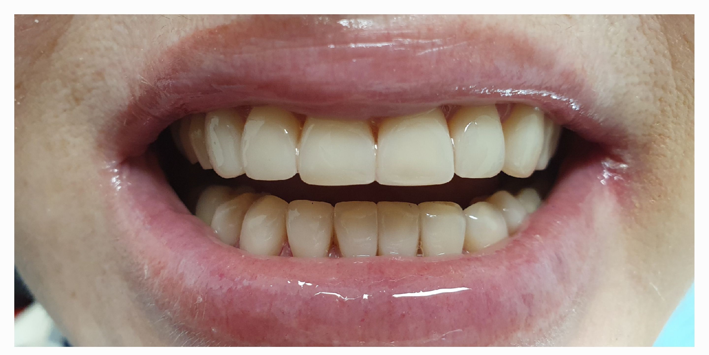 Композитные виниры