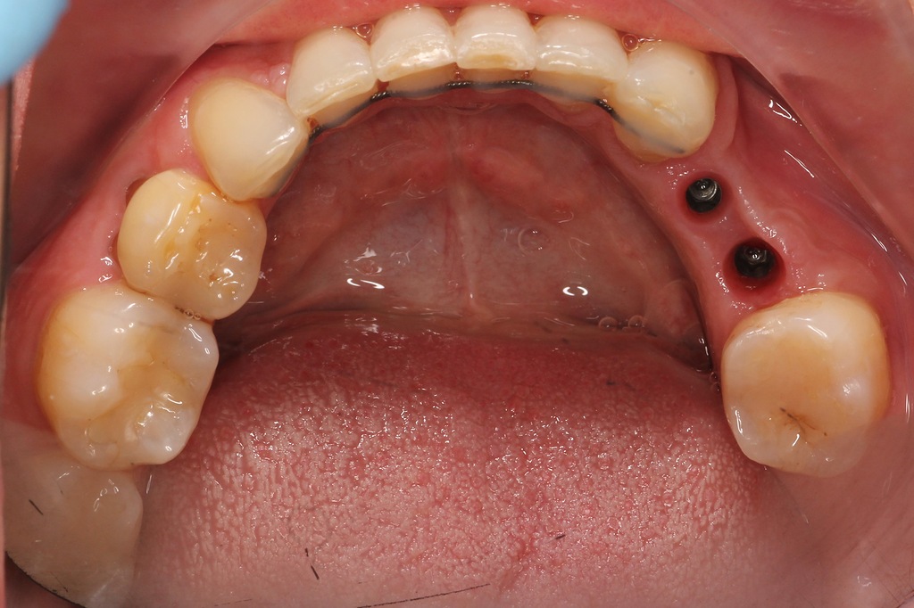 Имплантация 4 и 5 зубов нижней челюсти