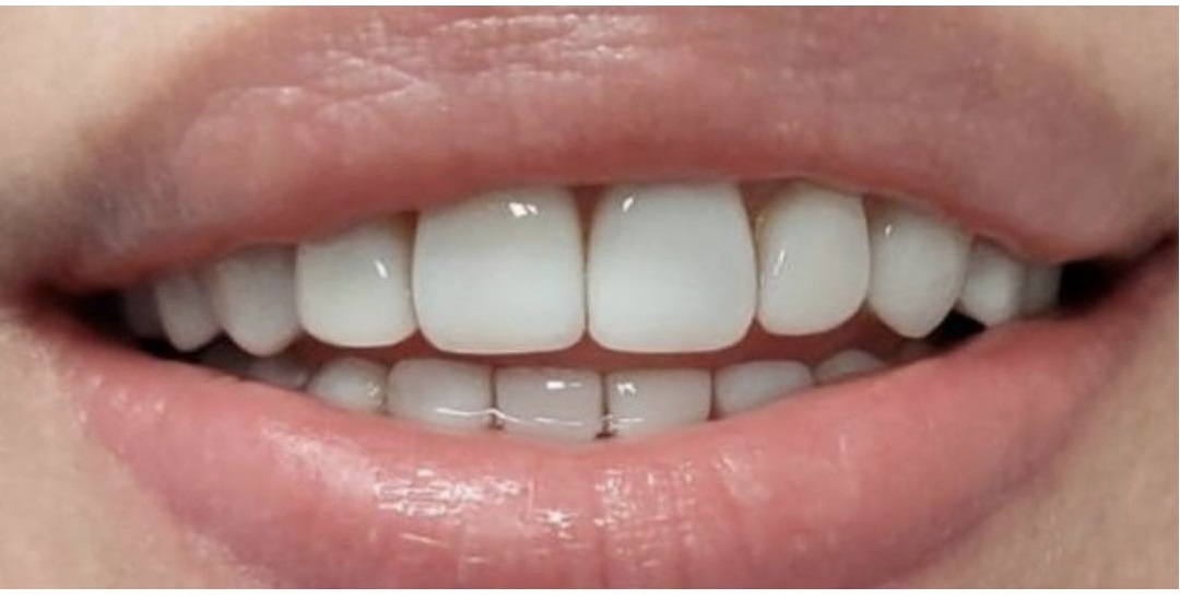 Композитные виниры