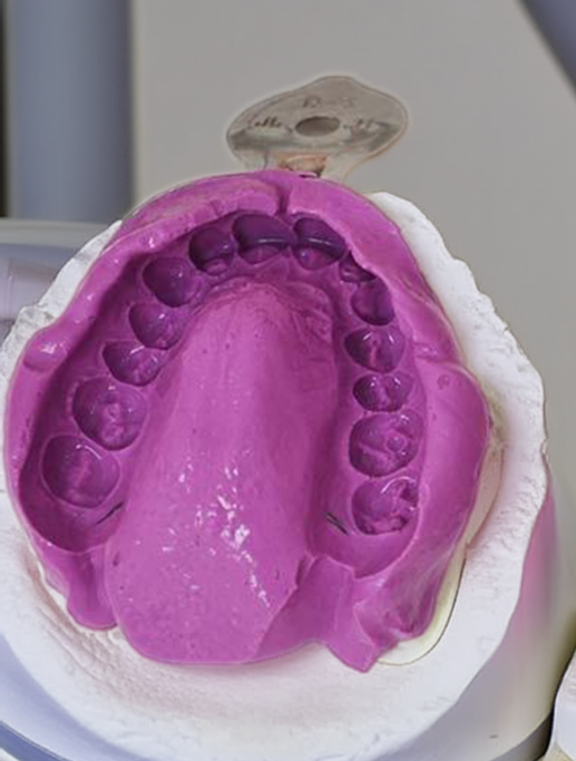 Снятие слепков (оттисков)