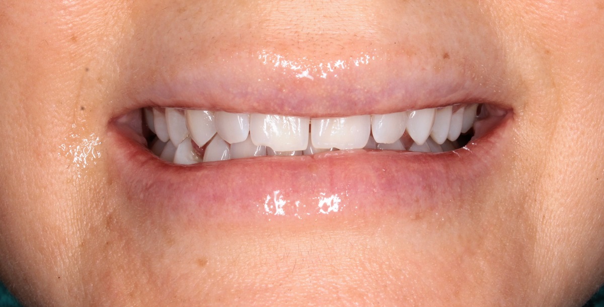 Керамические виниры