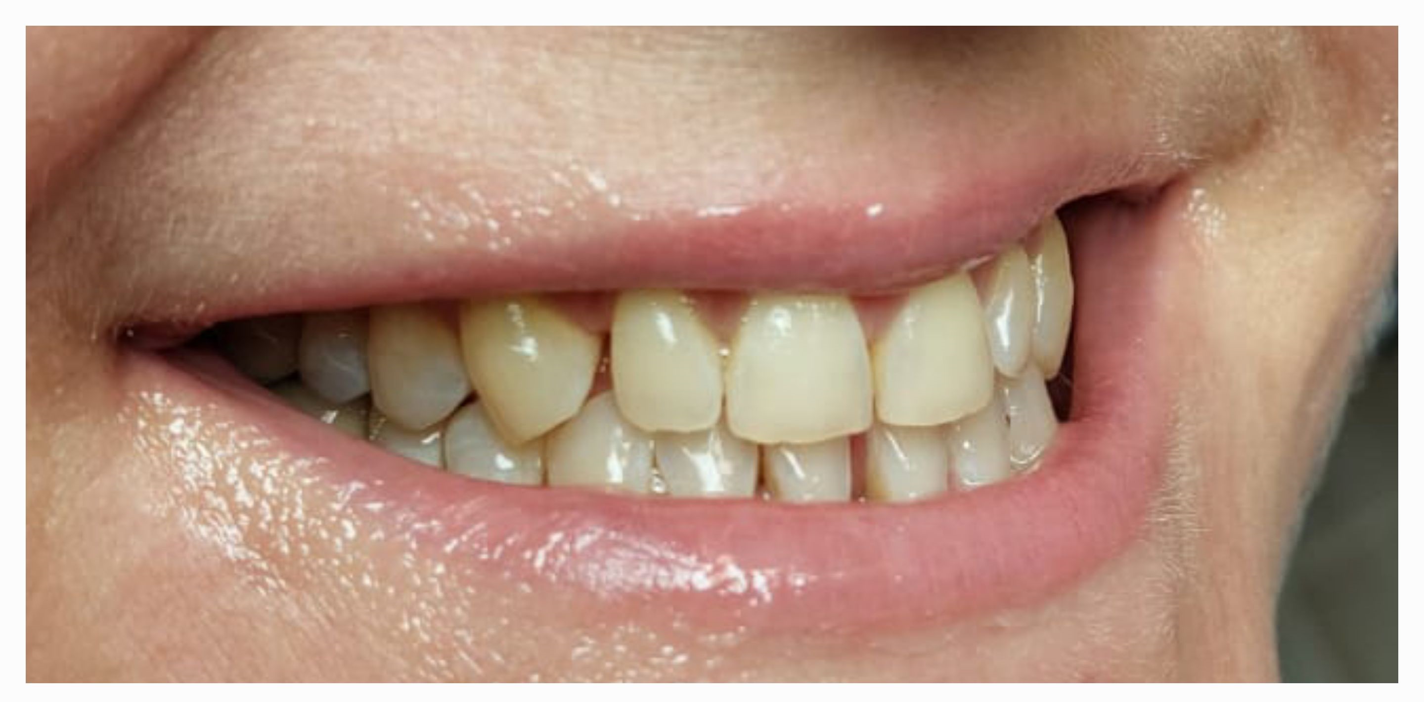 Композитные виниры