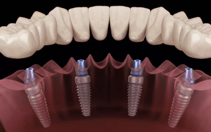 Рекомендации после имплантации зубов