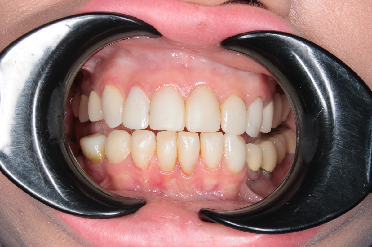 Керамические виниры