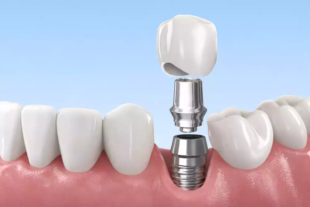 Виды зубных имплантов: какие лучше выбрать в 2026 году