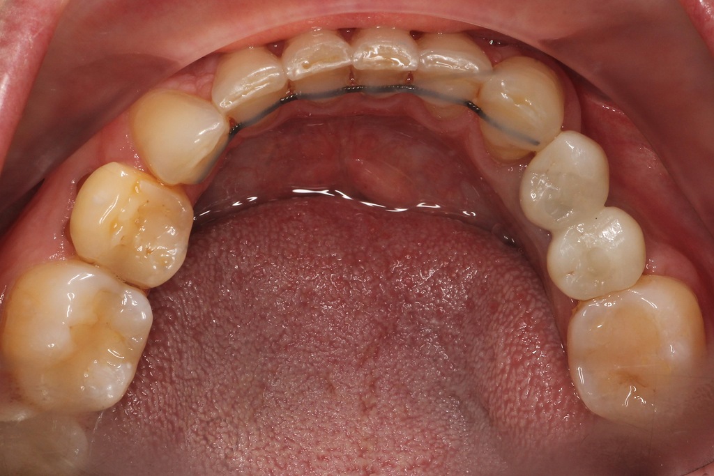 Имплантация 4 и 5 зубов нижней челюсти