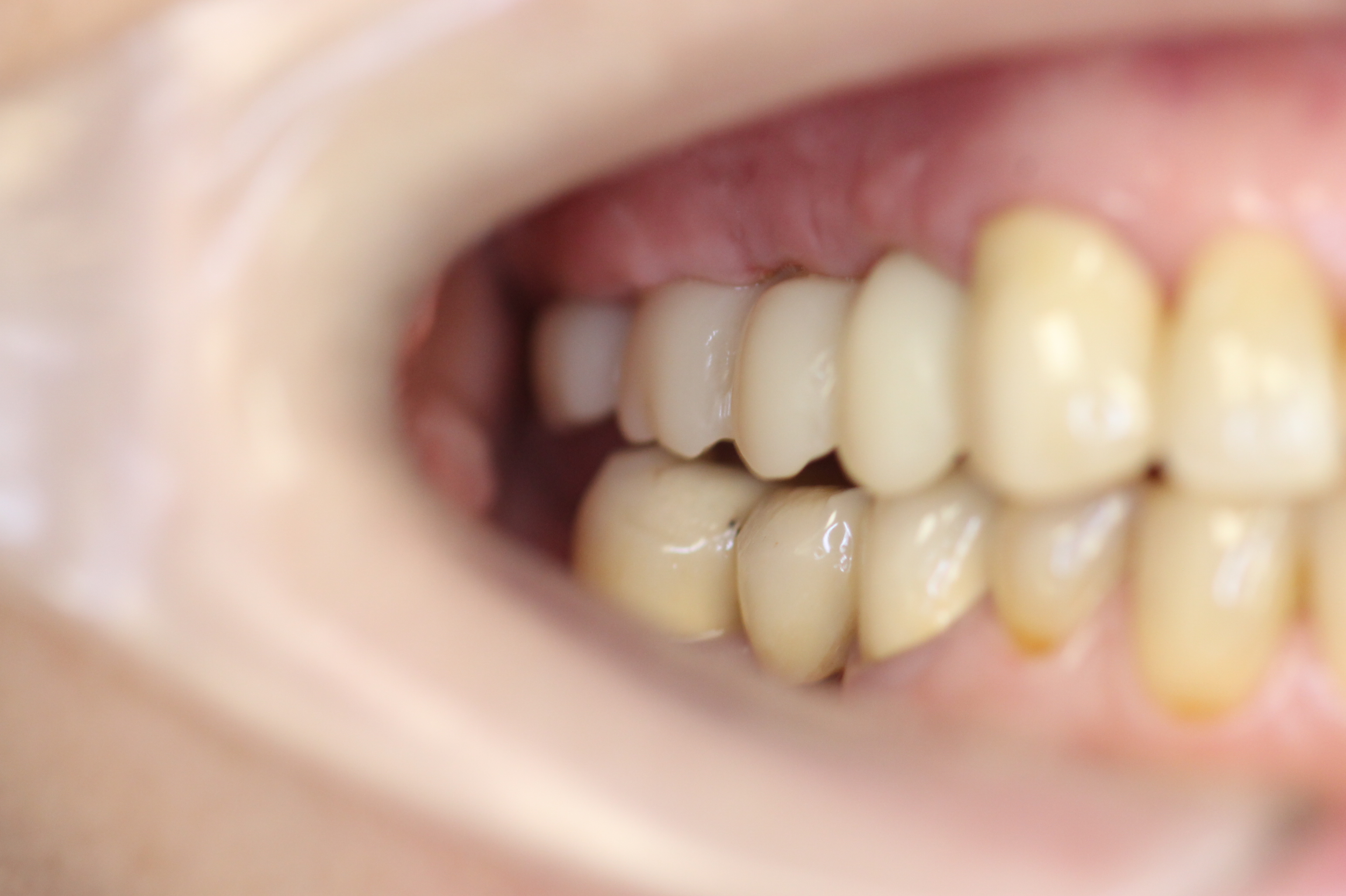 Десневая пластика в области имплантатов