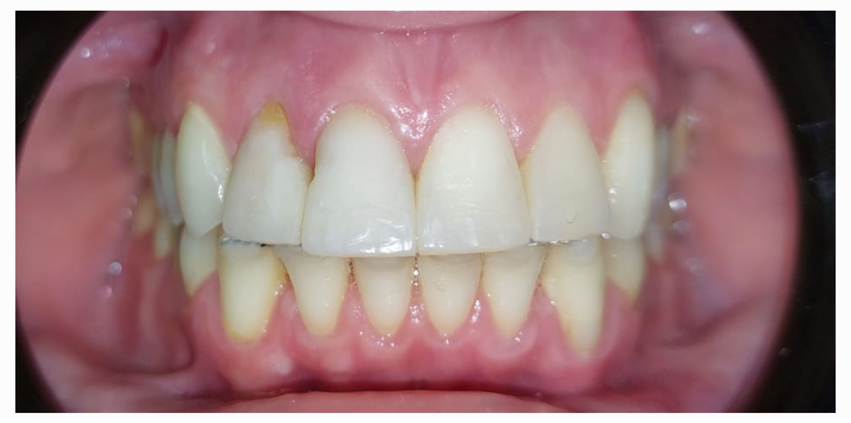 Композитные виниры