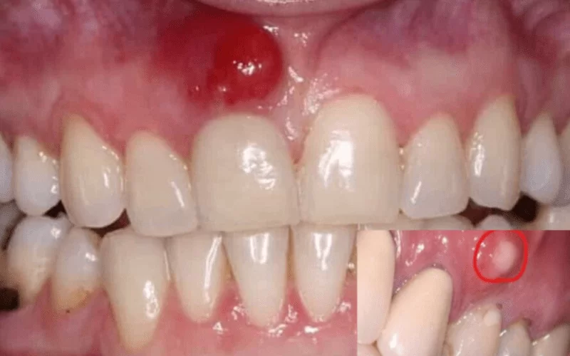 Гранулематозный периодонтит: симптомы, диагностика, лечение