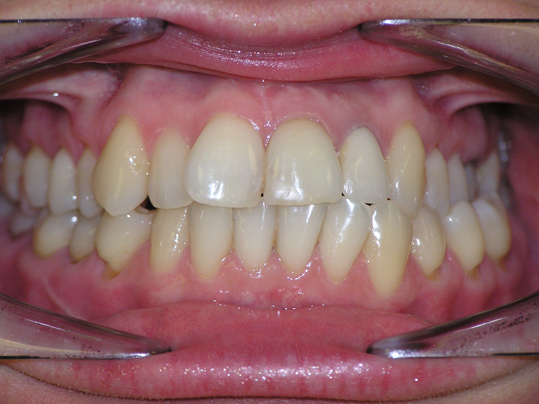 Исправление прикуса брекетами