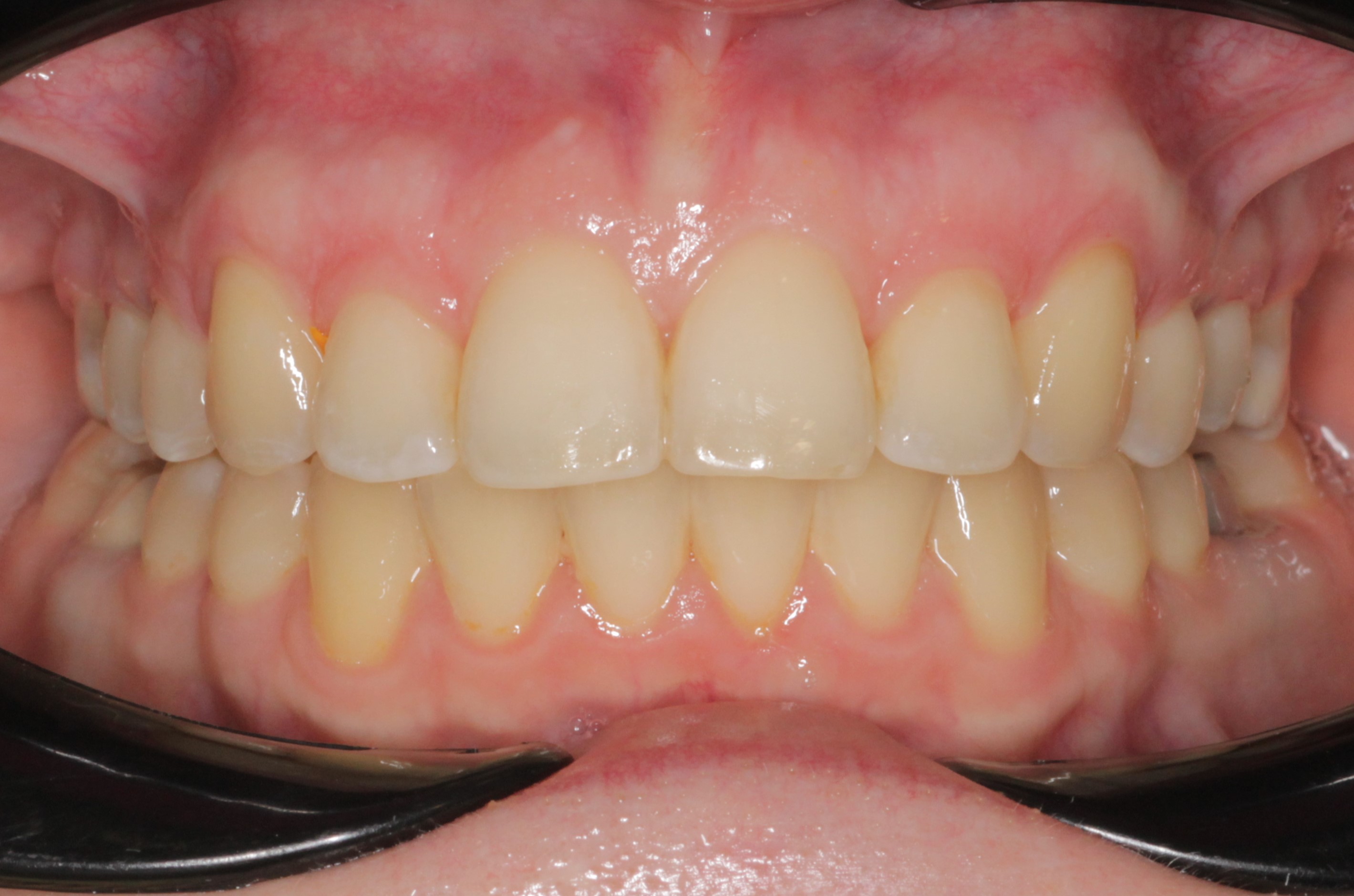 Исправление прикуса брекетами