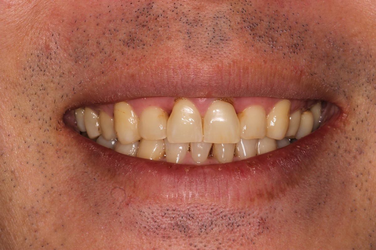 Керамические виниры