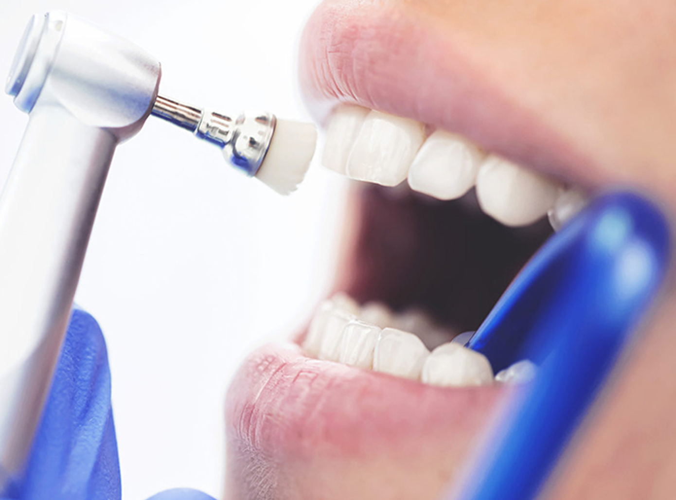 Снятие зубного камня Air Flow