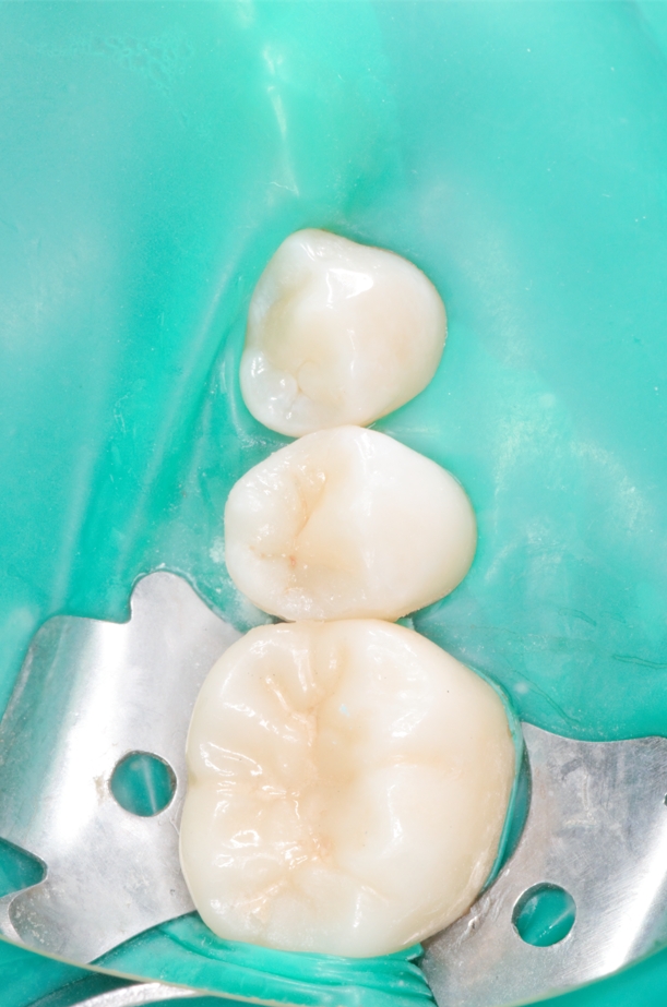 Лечение кариеса