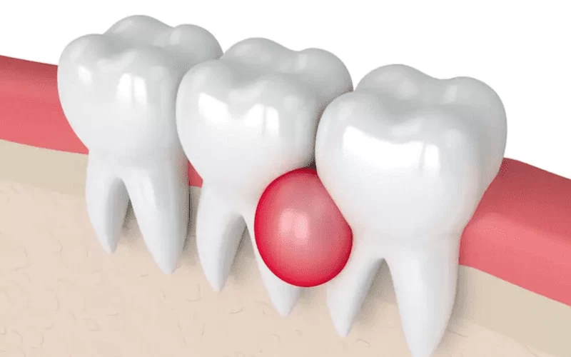 Гранулематозный периодонтит: симптомы, диагностика, лечение