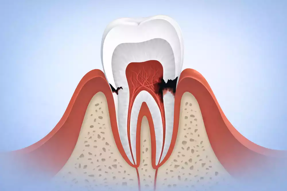 Кариес корня зуба: лечить или удалять