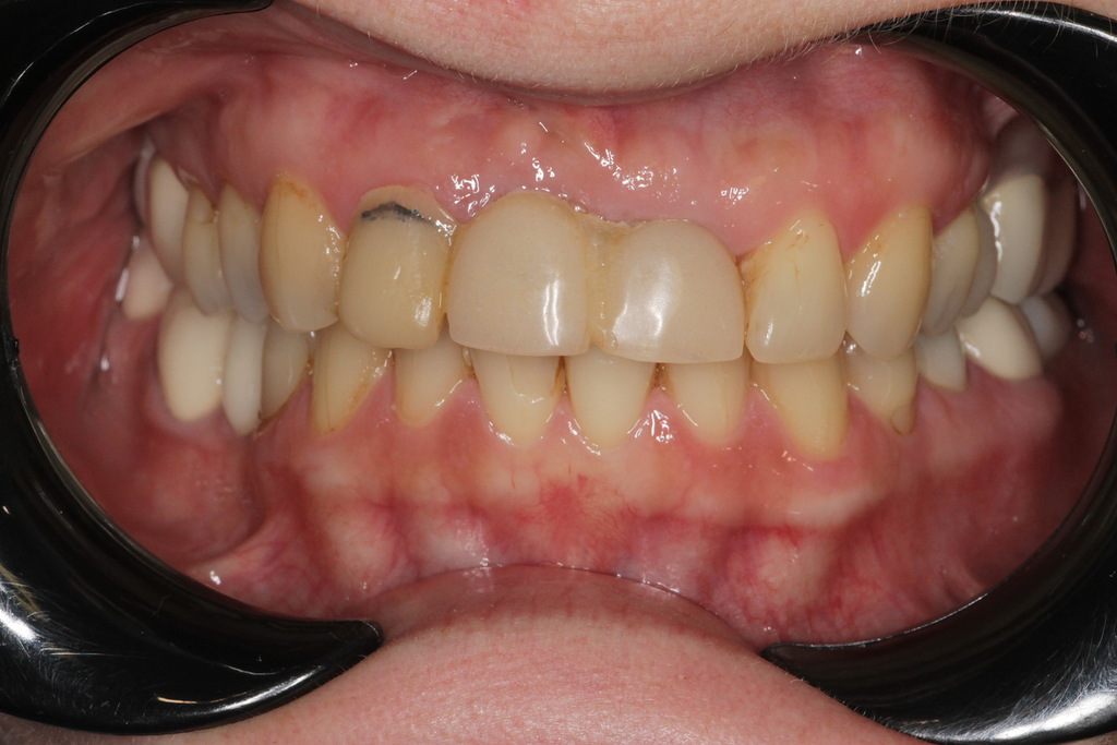 Коронки E-max