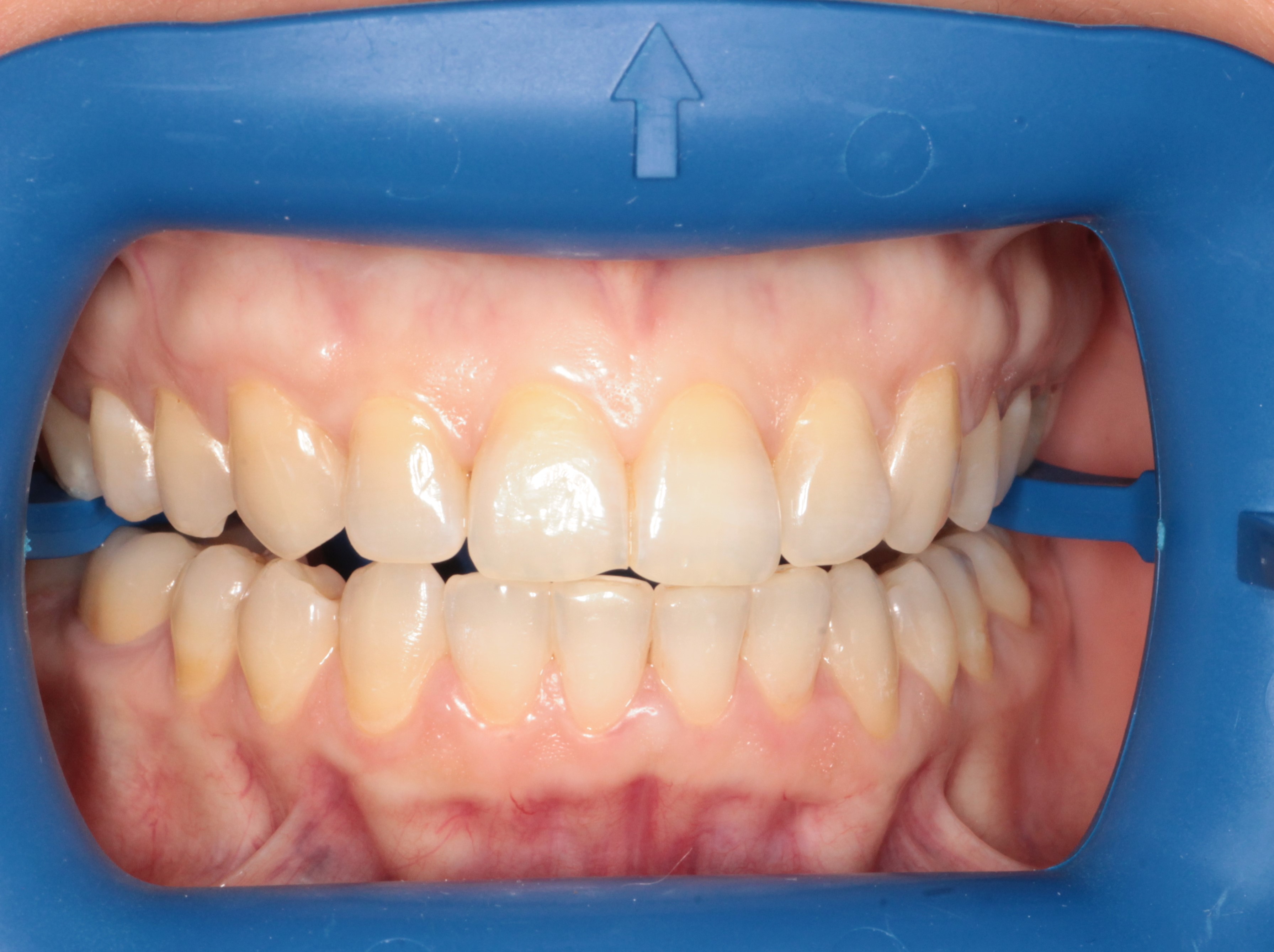 Отбеливание