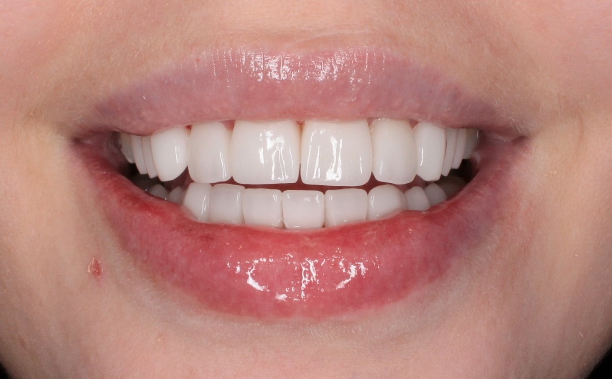 Керамические виниры