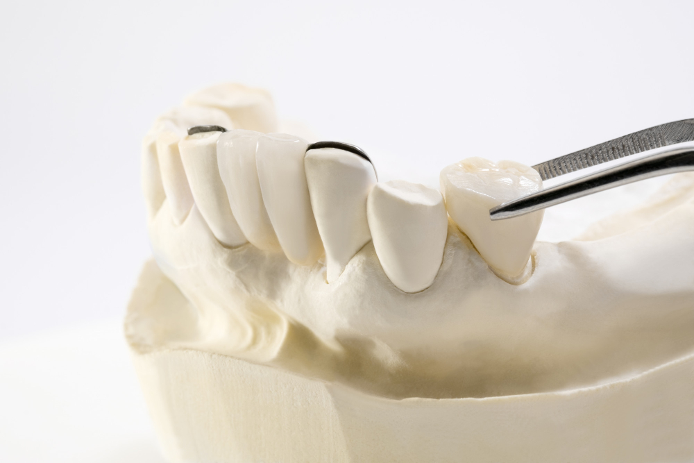 Зубные коронки