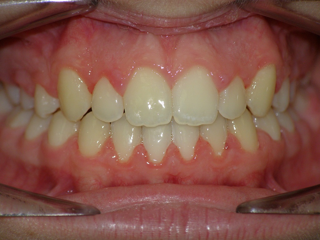 Исправление прикуса