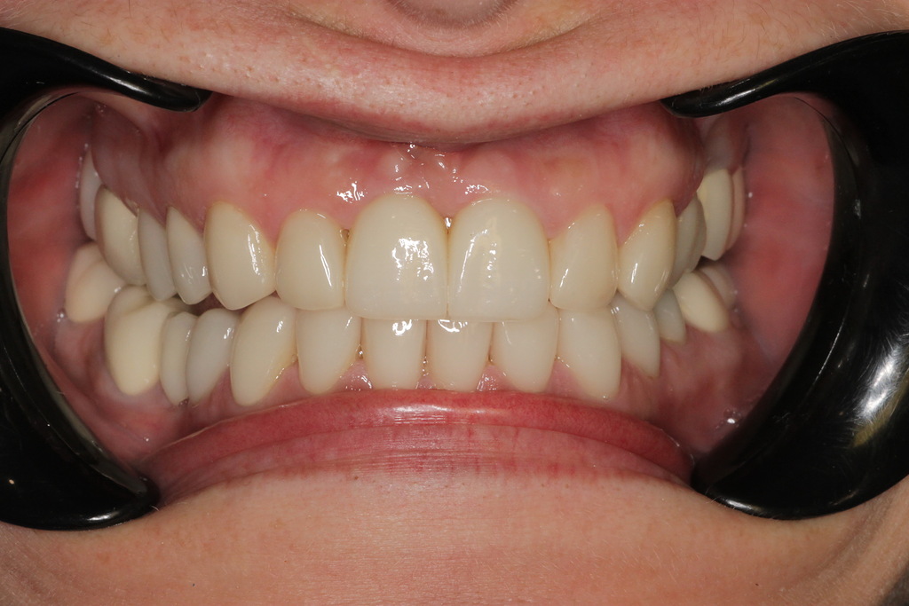 Коронки E-max