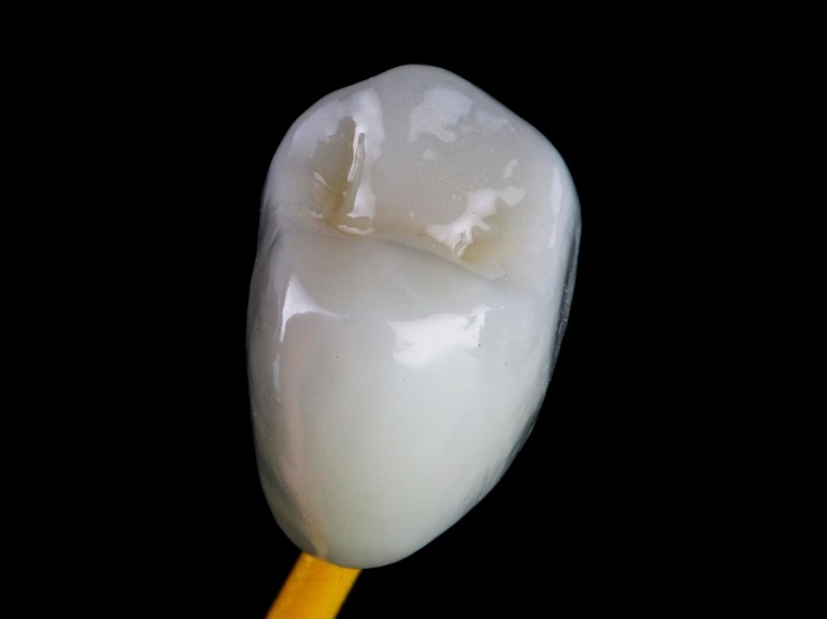 Металлокерамические коронки